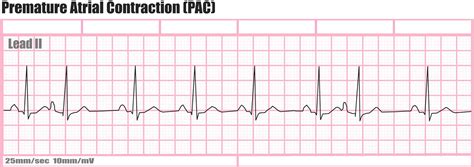 Ectopic Heartbeat - Causes, Symptoms, Diagnosis, Treatment