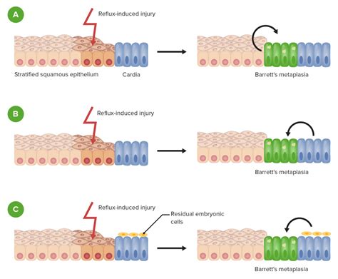 Barrett Esophagus | Concise Medical Knowledge