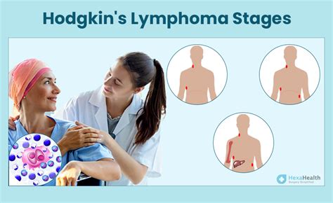 Hodgkin's Lymphoma: Symptoms, Causes, Stages, Treatment