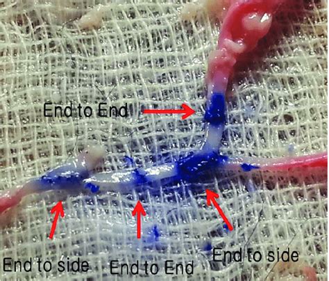 End-to-side anastomosis is practiced first, followed by end-to-end... | Download Scientific Diagram