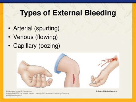 Ch08 presentation bleeding