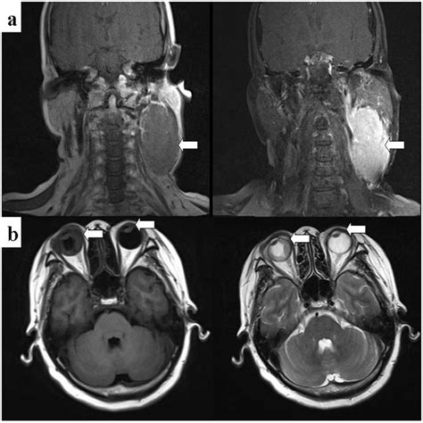 Multiple myeloma with extramedullary plasmacytoma invading the skin and eyeballs following ...