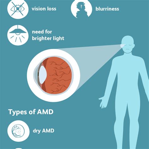 Macular Degeneration: Signs and Symptoms