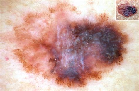 Dermoscopy of Melanocytic Neoplasms: Subpatterns of Melanoma—Degrees of Malignancy | Dermatology ...