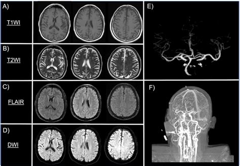 MRI of the head did not show acute stroke on T1WI, T2WI, FLAIR and DWI ...