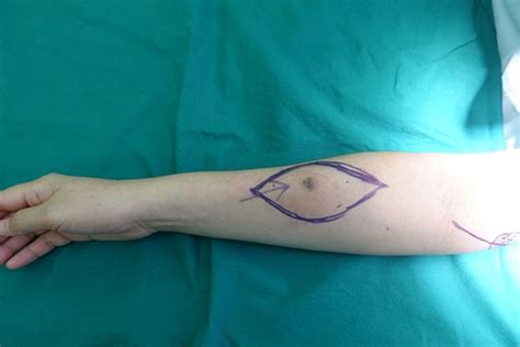 Which Area Of The Arm Drains To The Epitrochlear Nodes - Best Drain ...