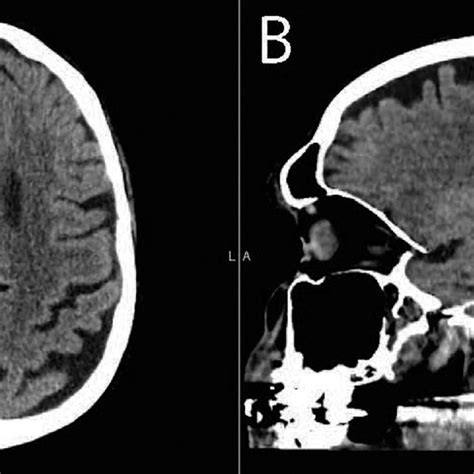 (PDF) Differential diagnosis of a ring-enhancing brain lesion in the ...