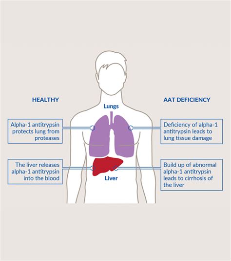 Alpha1 – Alpha-1 antitrypsin deficiency (Alpha-1) is a genetic condition which can cause lung ...