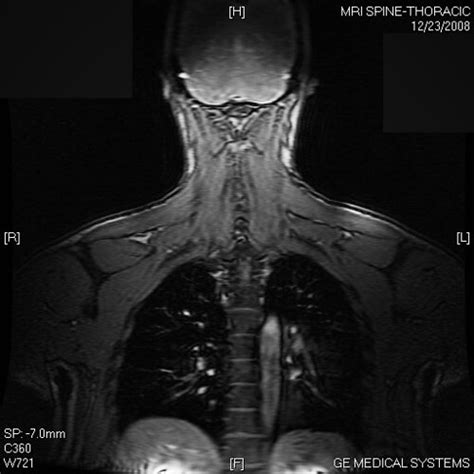 Back - Thoracic MRI | A shot of back muscle and a peek into … | Flickr