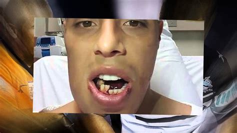 Rugby league player suffers 'worst broken jaw injury' doctors have ever ...