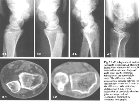 Distal radioulnar joint subluxation and dislocation diagnosed by standard roentgenography ...