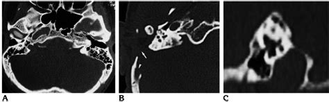 Vessel canal aberrations. A , Axial CT scan at the level of the foramen... | Download Scientific ...