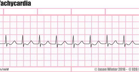 ECG Educator Blog : Junctional Tachycardia