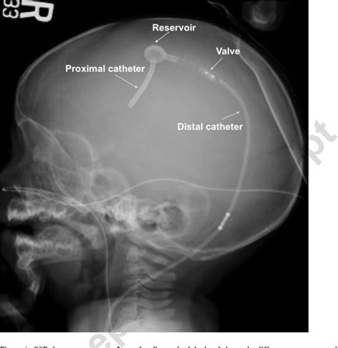 Figure 1 from Imaging of Ventricular Shunts. | Semantic Scholar