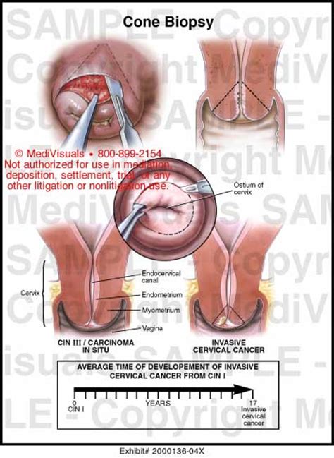 Cone Biopsy Medical Exhibit Medivisuals