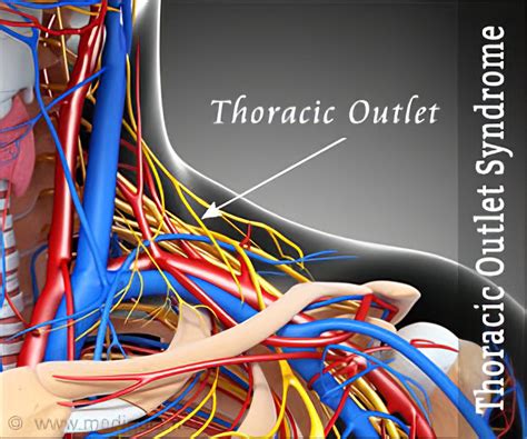 Thoracic Outlet Syndrome - Symptoms Diagnosis Treatment Remedies