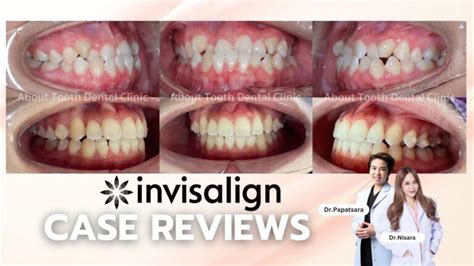 Invisalign Case Reviews - About Tooth Dental Clinic