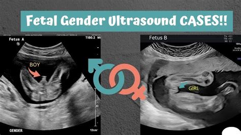 Girl Gender Ultrasound 100% Original | www.gbu-presnenskij.ru