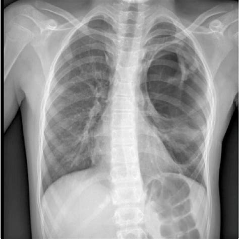 Chest CT scan at 6 months follow-up highlighting a residual pneumatocele. | Download Scientific ...