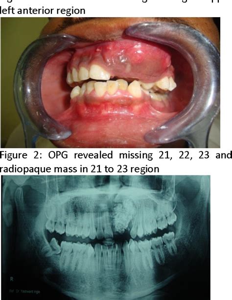 Figure 2 from ODONTOMA (Complex Composite Odontome ) | Semantic Scholar