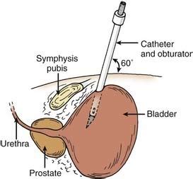 Suprapubic Urinary Catheter