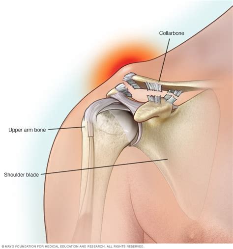 Separated shoulder - Symptoms and causes - Mayo Clinic