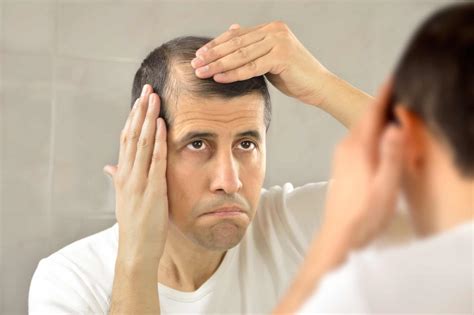 Receding hairline: Causes, Symptoms and Treatment - RepHair