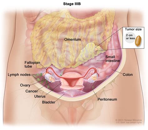 Ovarian Epithelial, Fallopian, & Peritoneal Cancer Treatment (PDQ®) - NCI