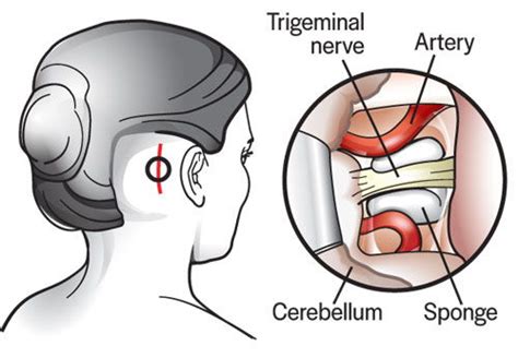 Best Hospitals for MICROVASCULAR DECOMPRESSION (MVD) SURGERY in HYDERABAD, Cost of MICROVASCULAR ...