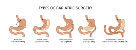 Introduction to Bariatric Surgery | Bariatric Clinic Singapore | By G ...