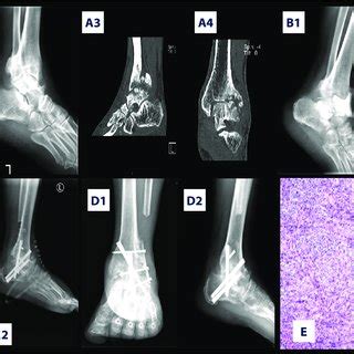 A representative case. A 50-year-old man with ankle infected bone... | Download Scientific Diagram