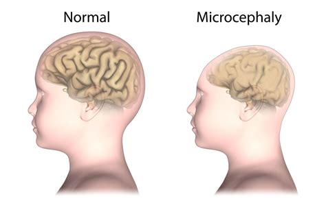 MEDIKA KEPERAWATAN: ASKEP PADA PASIEN MICROCEPHALUS