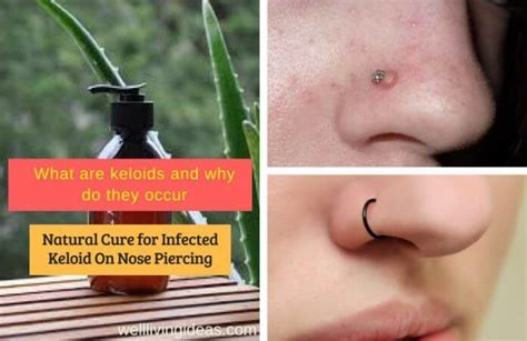 Keloid Scar From Nose Piercing