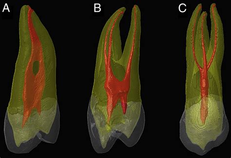 Root and Root Canal Morphology of Maxillary First Premolars: A ...