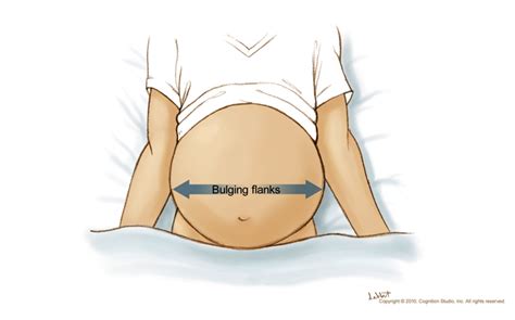 How To Check For Ascites - Longfamily26