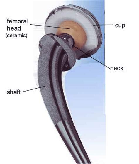 Advanced Orthopaedic Center India: Ceramic Hip Replacement - The Safest ...