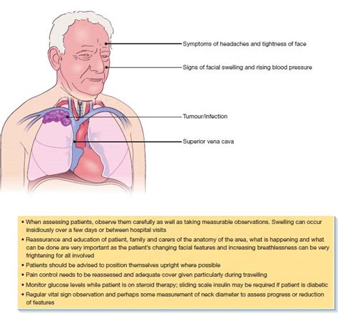 Emergencies: superior vena cava obstruction | Nurse Key