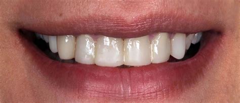 Emax Veneers London: Enhance Dental Aesthetics with E-max Veneers