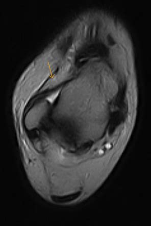 Anterolateral Ankle Impingement-MRI - Sumer's Radiology Blog