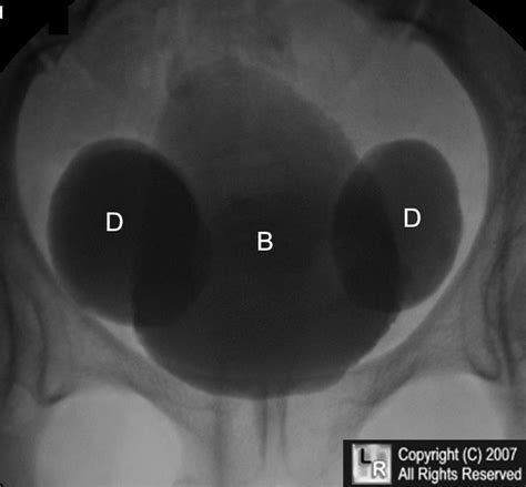 Learning Radiology - bladder, diverticulum, tic, divertula, urinary, xray, x-ray, student ...