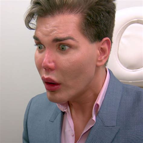 Botched Patient Rodrigo Alves Learns His Nose Could Die and Fall Off After Extreme Plastic ...