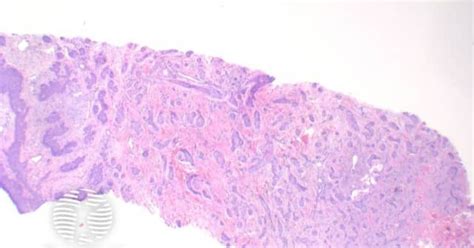 Basal cell carcinoma pathology image