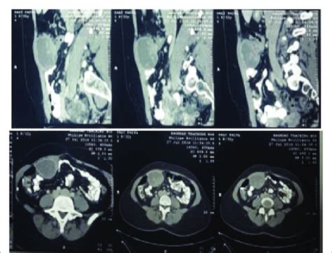 Abdominal CT scan shows mass of endometriosis. | Download Scientific Diagram