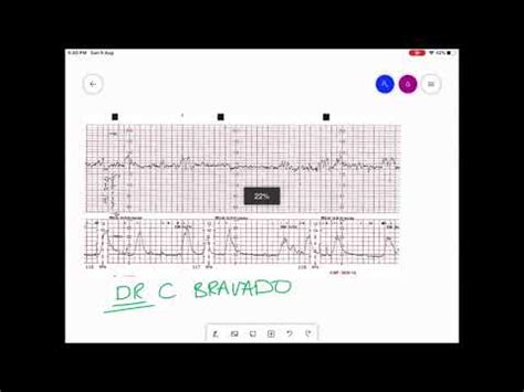 CARDIOTOCOGRAPHY | CTG INTERPRETATION - YouTube