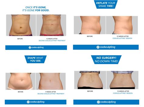 Coolsculpting fat removal reviews – Colororient