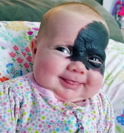 Baby born with huge 'Batman mask' birthmark on her face - Big World Tale