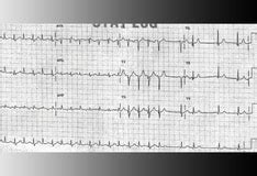 'Inappropriate' Sinus Tachycardia