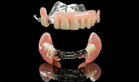 Removable Partial Denture