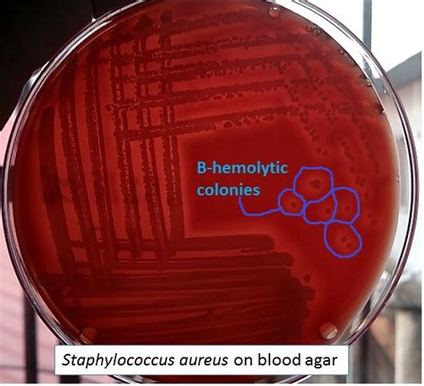 Beta hemolytic colony of Staphylococcus aureus on Blood agar and this