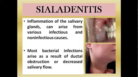 Inflamed Salivary Gland Under Tongue